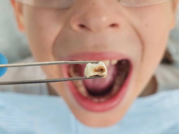 Emergency Gum Pain Relief in MS